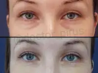 Блефаропластика, фотография 2