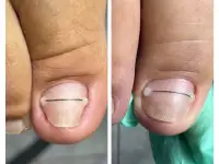 Педикюр Kart, медицинский, фотография 4