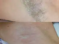 Шугаринг, фотография 2