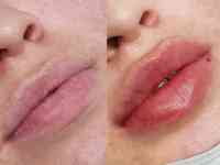 Косметолог Увеличение губ, фотография 4