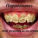Пародонтоз - уникальный метод исцеления