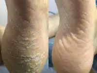 Педикюр Kart, медицинский, фотография 2