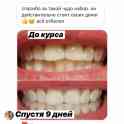 Отбеливание для зубов Happy Smile, фотография 11