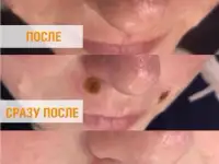 Лазерное удаление бородавок, родинок., фотография 4