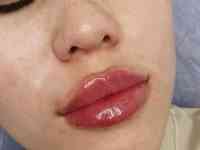 Косметолог Увеличение губ, фотография 10