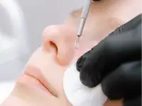 Чистка лица ( ультразвуковая, Вакуумная, механическая чистка), фотография 2