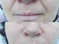 Косметолог Увеличение губ, фотография 6