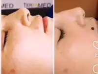 Лазерное удаление бородавок, родинок., фотография 3