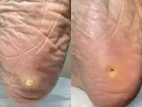 Педикюр Kart, медицинский, фотография 5