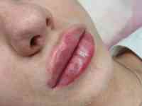 Косметолог Увеличение губ, фотография 3