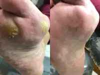 Педикюр Kart, медицинский, фотография 3