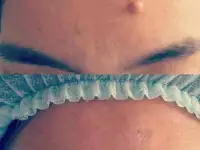 Лазерное удаление бородавок, родинок., фотография 2