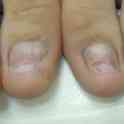 Вросший ноготь.Протезирование., фотография 2