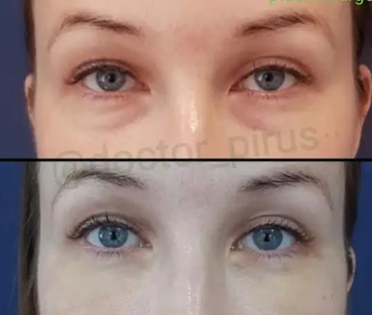 Блефаропластика, фотография 2