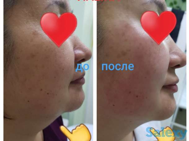 Смас лифтинг, фотография 4