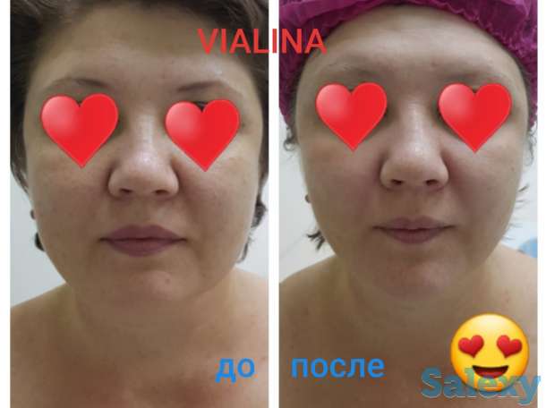 Смас лифтинг, фотография 6