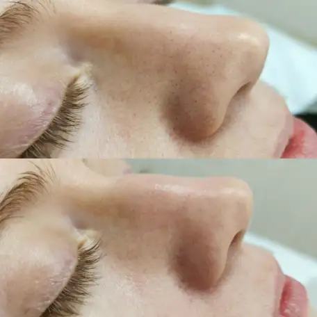 Приглашаю на первую БЕСПЛАТНУЮ косметологическую процедуру, фотография 3