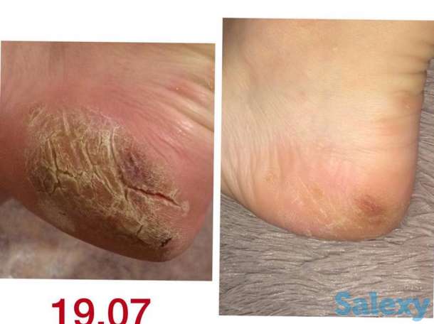 Решение проблем стоп и ногтей в Алматы, фотография 4