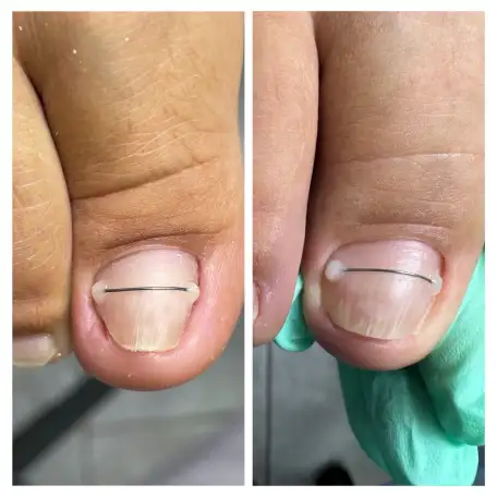 Педикюр Kart, медицинский, фотография 4
