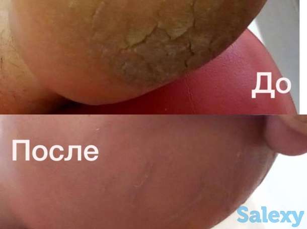Решение проблем стоп и ногтей в Алматы, фотография 1