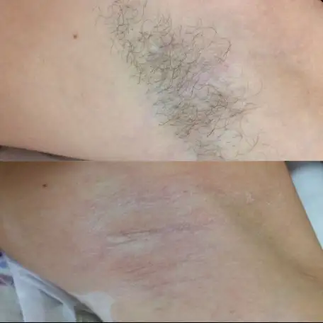 Шугаринг, фотография 2