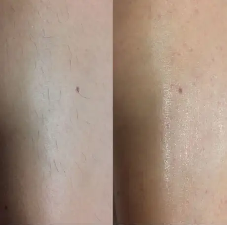 Шугаринг, фотография 4