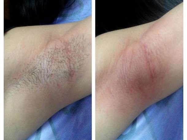 Шугаринг по доступным ценам, фотография 3