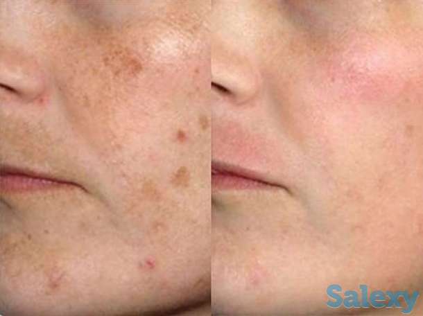 Пришло время бороться с пигментацией!!, фотография 1