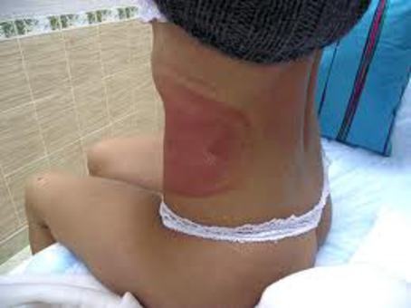 КРИОЛЕПОЛЕЗ-Липосакция замораживанием - новый высокоэффективный метод., фотография 2