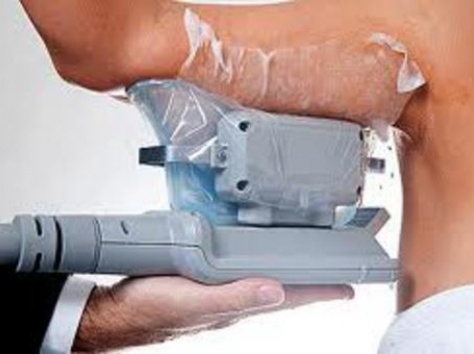 КРИОЛЕПОЛЕЗ-Липосакция замораживанием - новый высокоэффективный метод., фотография 4