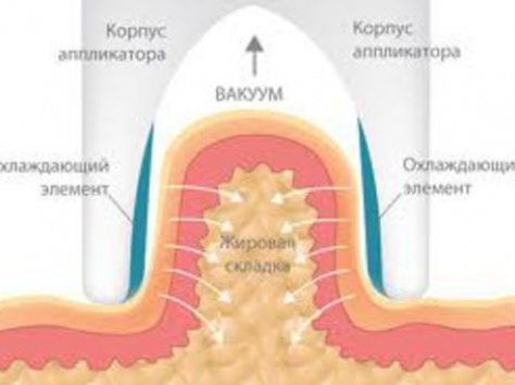 КРИОЛЕПОЛЕЗ-Липосакция замораживанием - новый высокоэффективный метод., фотография 5