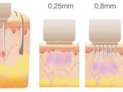 Омоложение лица – RF-лифтинг нового поколения, фотография 2