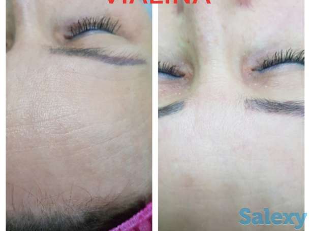 Смас лифтинг, фотография 1