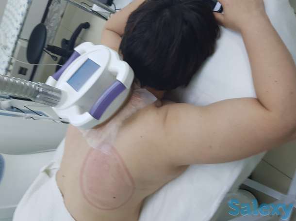 Криолиполиз, фотография 10