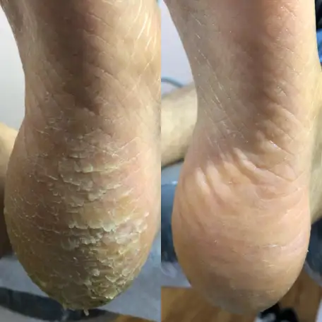 Педикюр Kart, медицинский, фотография 2