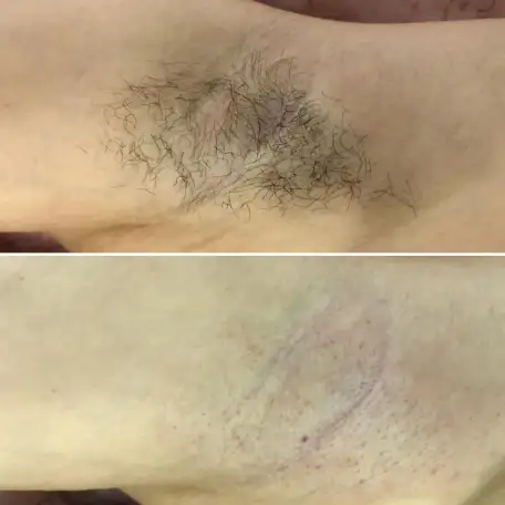 Шугаринг, фотография 1