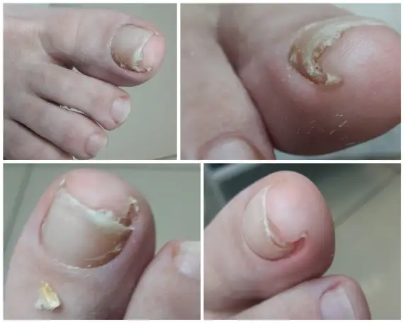 Заболевание ногтей, онихолизис ногтей, вросший ноготь!Подолог-миколог!, фотография 1
