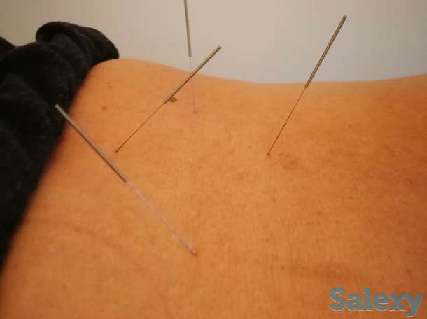 Иглотерапия, массаж, Хиджама, ЛФК, лечение огнём, баночный массаж, фотография 3