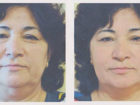 Лицо. Лифтинг. Эстетическое мануальное моделирование лица., фотография 1