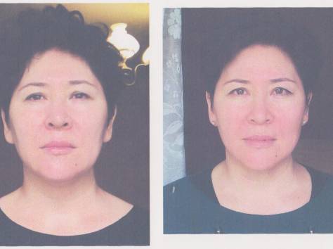 Лицо. Лифтинг. Эстетическое мануальное моделирование лица., фотография 2