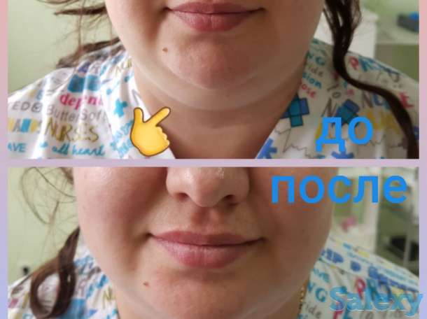 Смас лифтинг, фотография 11