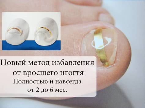 Как избавиться от вросшего ногтя в Алматы? , фотография 2