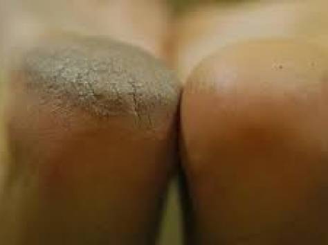 коррекция вросших ногтей,аппаратный педикюр.наращивание ногтей, фотография 4