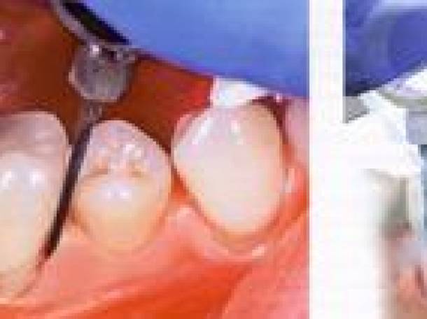 Лечение десен с аппаратом Вектор, фотография 3