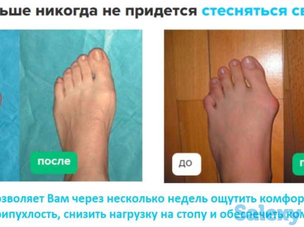 Магнитная вальгусная шина MagnetFix бандаж, фотография 3