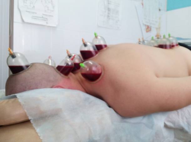 Кровопускание Хиджама , фотография 1