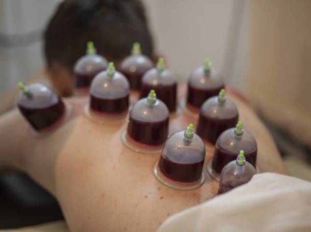 Хиджама кровоспускание, фотография 1