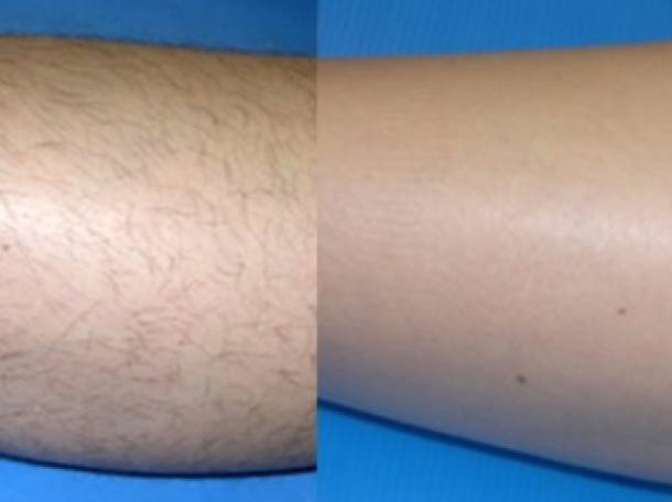 Шугаринг , фотография 1