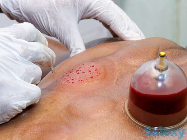 Хиджама и Массаж, фотография 2