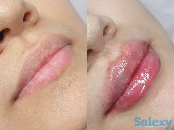 Косметолог Увеличение губ, фотография 2